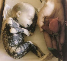 aborted baby